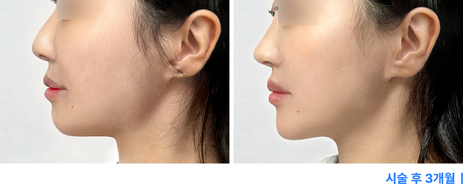 전후사진