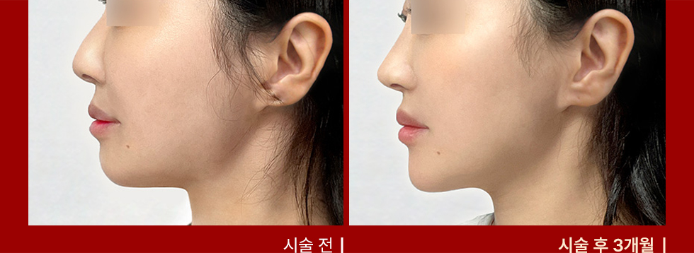 전후사진