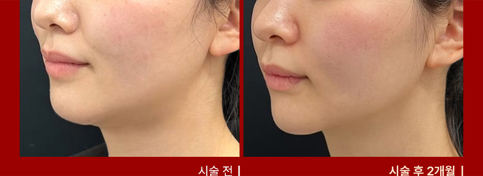 전후사진