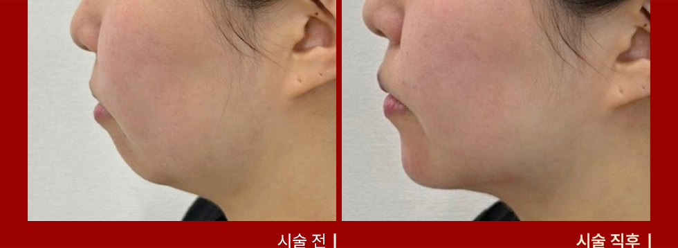 전후사진