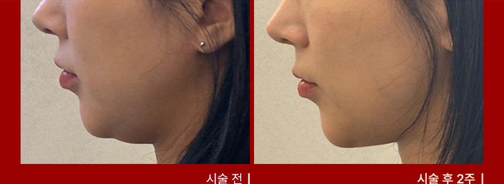 전후사진