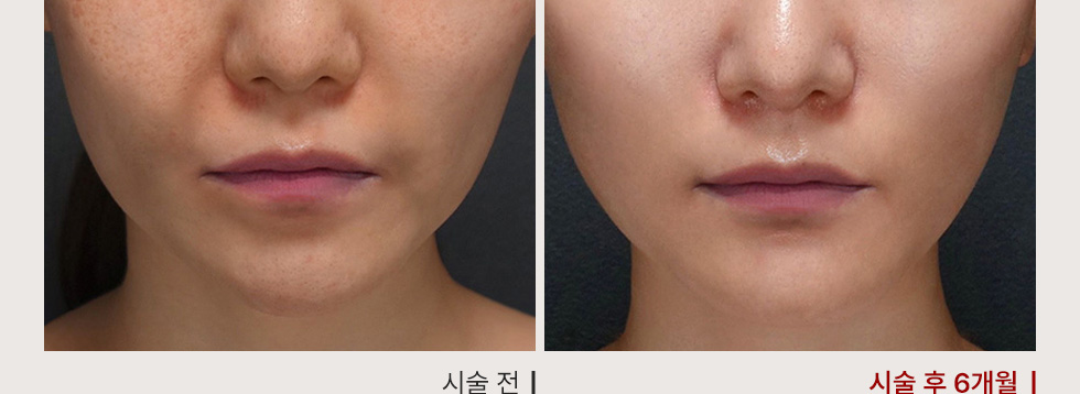 전후사진
