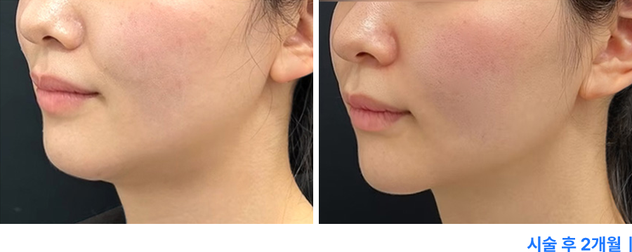 전후사진