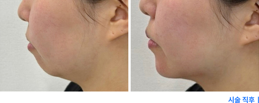 전후사진