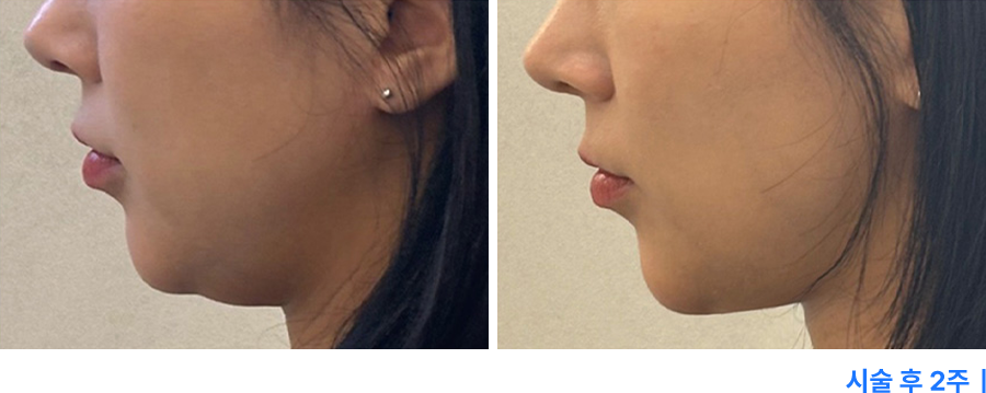 전후사진