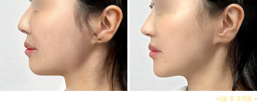 전후사진