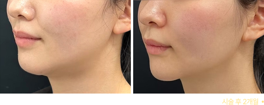전후사진