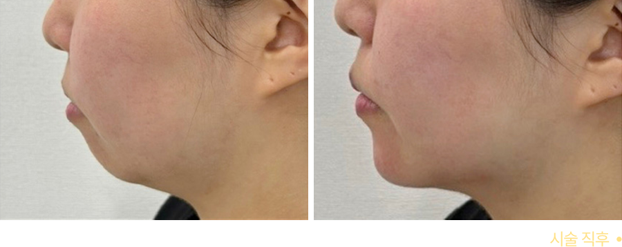 전후사진
