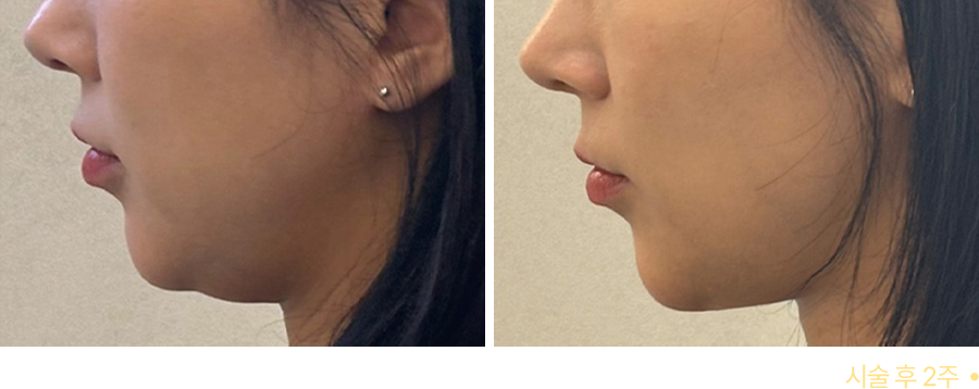 전후사진
