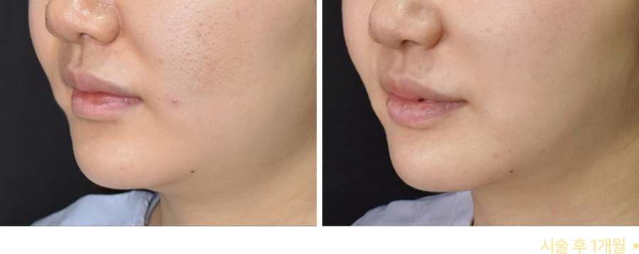 전후사진