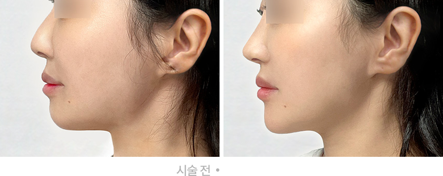 전후사진