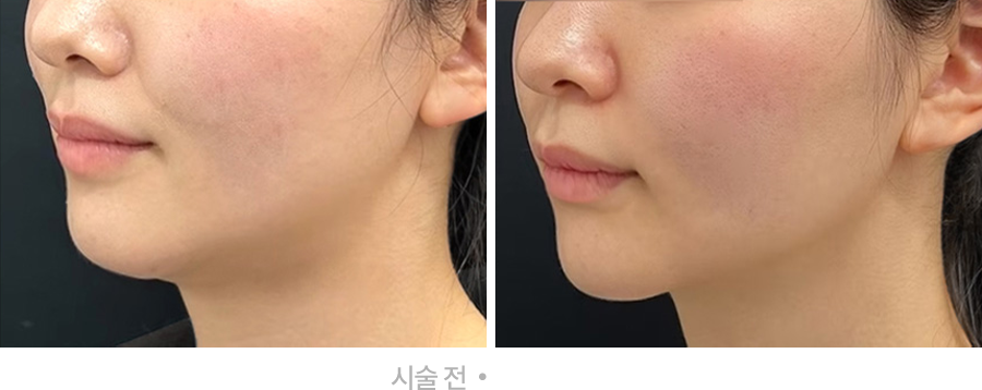 전후사진