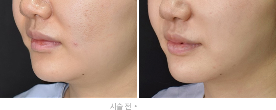 전후사진